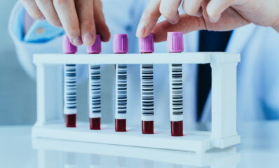 Scientist examining blood samples in a lab - featured image to illustrate primary progressive ms and secondary progressive ms differences