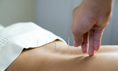 Person receiving acupuncture as a treatment for multiple sclerosis